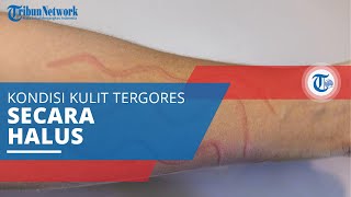 Dermatographia, Kondisi bila Seseorang Tergores Kulitnya secara Halus
