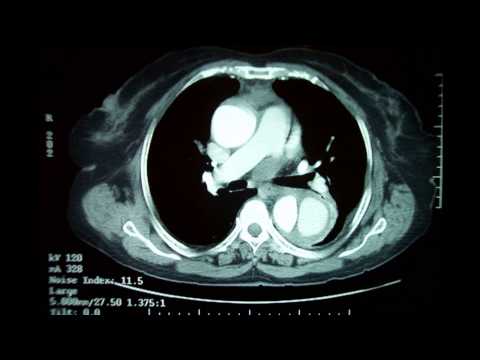 Aortic Dissection Awareness (Original Mix)