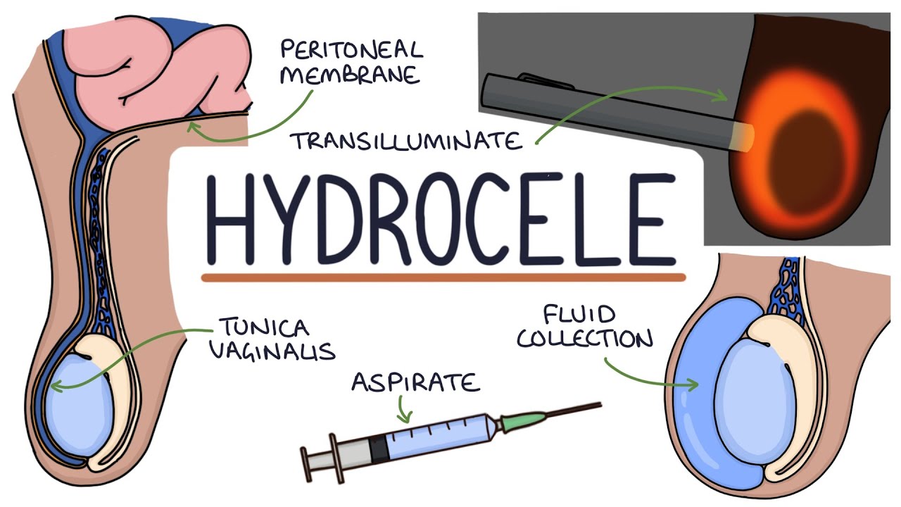 Understanding Hydroceles