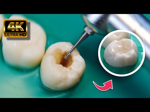 AWESOME dental restoration in 4K