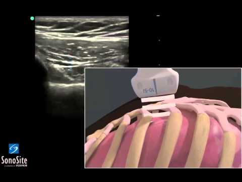 3D Lehrvideo: EFAST - Lungenuntersuchung mit einem Linearschallkopf