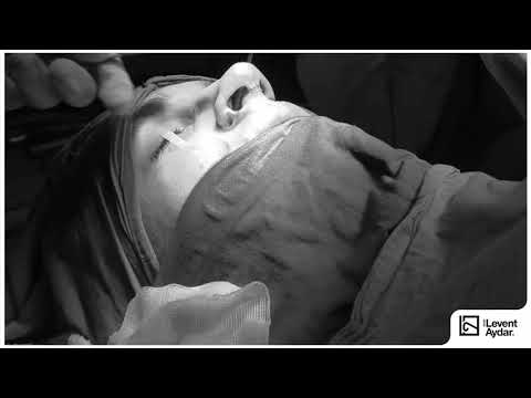 Levent Aydar Rhinoplasty Ameliyatı