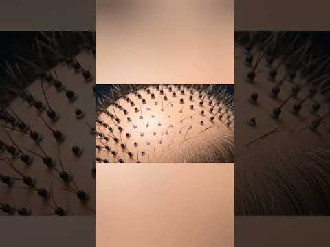 Dandruff: Why Your Scalp Flakes