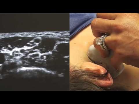 Ultrasound Guided Interscalene Nerve Block - SSRAUSA.com