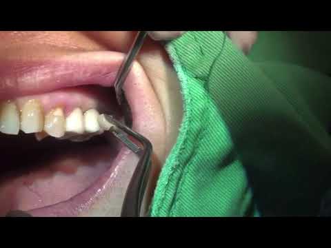 Veneer Removal and Periodontal Treatment with LIGHTMED's SAPPHIRE Laser
