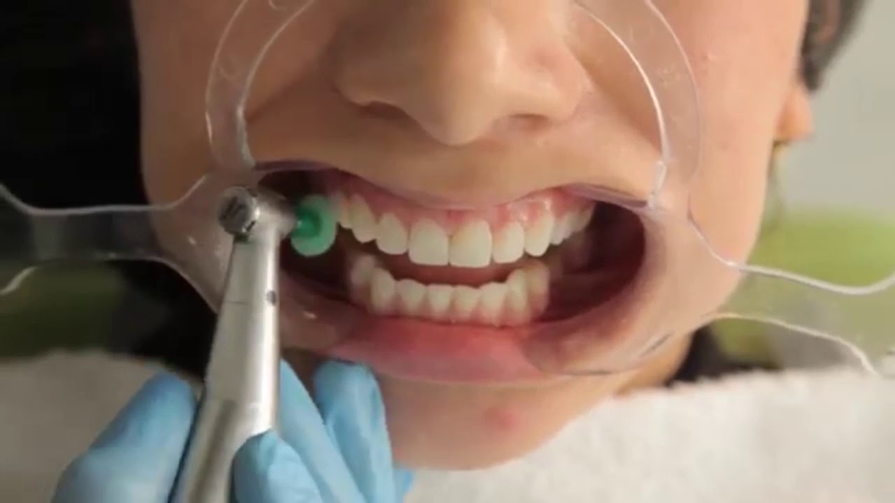 Acabado y pulido de Resinas en Odontología