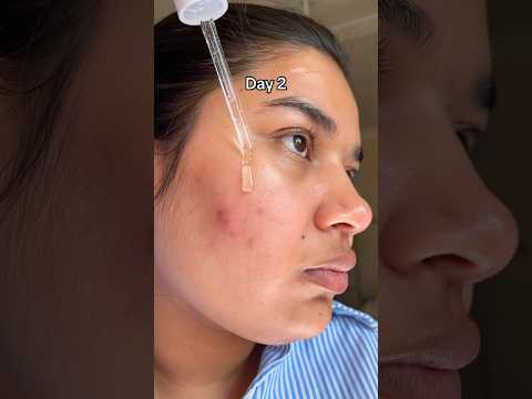 SKIN1004 tone brightening ampoule✅❄️#darkspots #hyperpigmentaiton #skincare#koreanskincare #centella