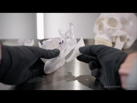 The Future of Facial Implants: Custom PEEK Design — Dr. Jonathan Zelken