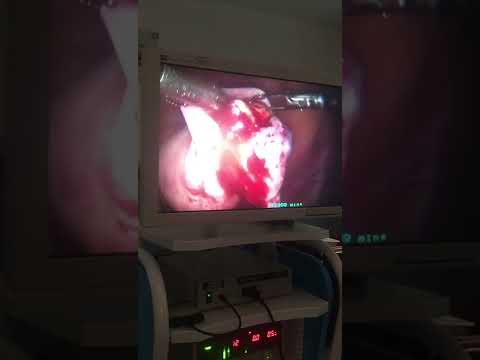 Retiro de quiste en ovarios Medellín - Dr. Juan Federico Zapata ginecólogo