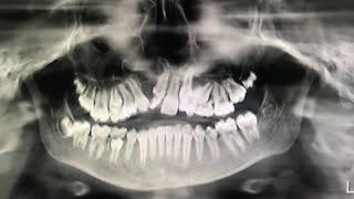 preview picture of video 'Cleft Maxillary Hypoplasia or Retrusion or Underbite correction'