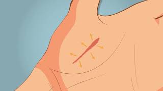 Silicone Sheeting and Scaring: How Sheeting Works on Scars