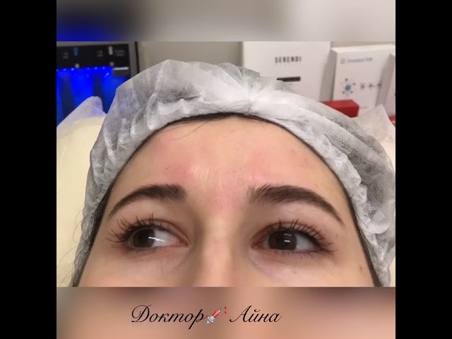 Коррекция морщин ботоксом