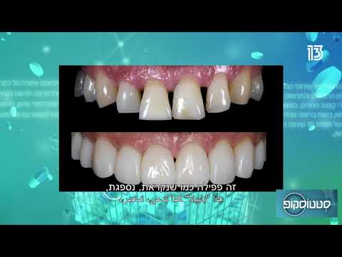 הדרך לחיוך מושלם: ציפויי חרסינה לשיניים