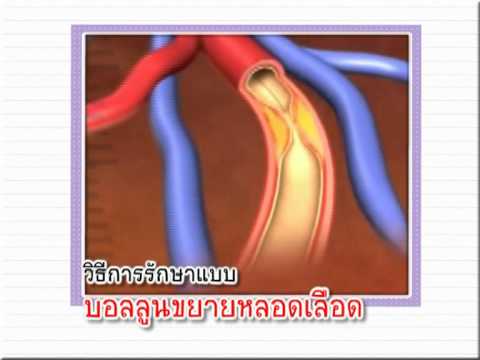 การรักษาความอ่อนแอวลา ผู้หญิงมี activators ดี