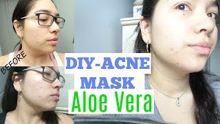 How to use Aloe Vera for Acne / my 1 week progress