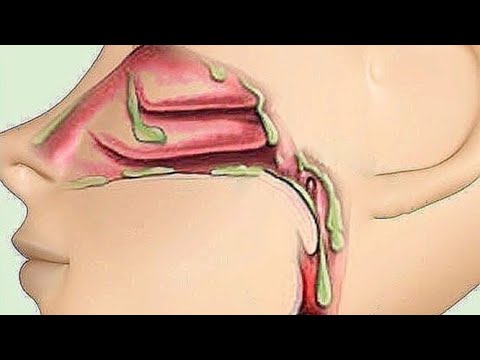 Слизь - причина многих болезней. Найдены новые органы в теле. Лимфа