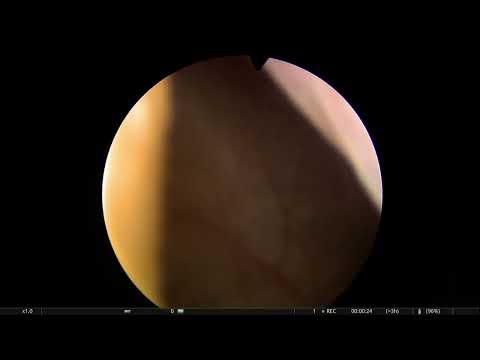 Złogi na niciach chirurgicznych w pęcherzu moczowym po zabiegu ginekologicznym