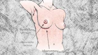 Where Are Breast Implant Incisions Made?