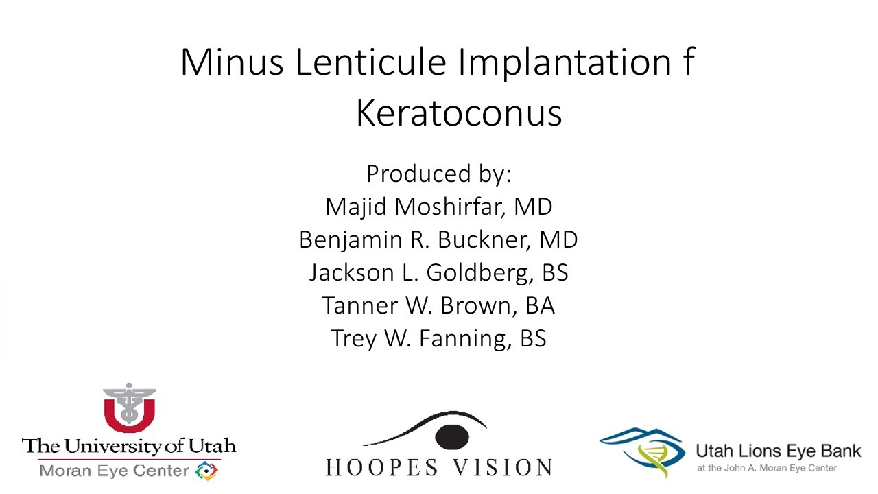 Minus Lenticule Implantation for Keratoconus