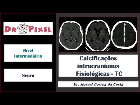 Calcificações intracranianas fisiológicas