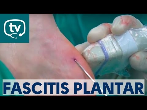 Todo sobre la fascitis plantar