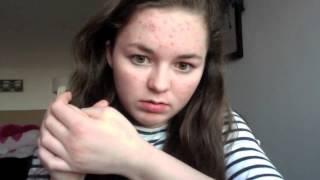 preview picture of video 'Roaccutane Diary: Skin #3 Week #2 Day #8'