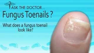 preview picture of video 'What does a Fungus Toenails Look Like? West Chester, Newtown Square, Audubon PA - Podiatrist'