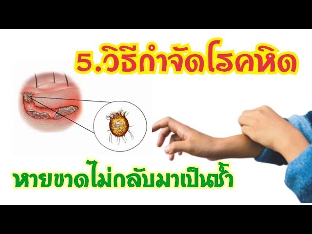 5.วิธีรักษาโรคหิด ให้หายขาดไม่กลับมาเป็นซ้ำ