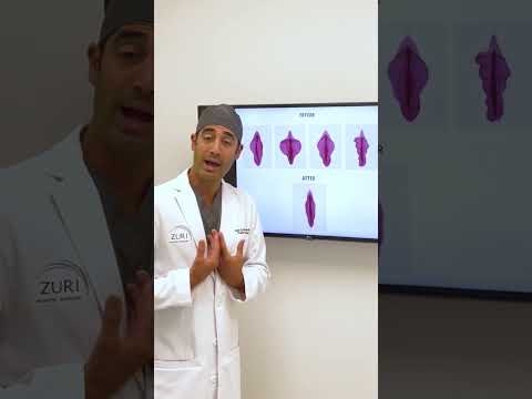 Labiaplasty with Dr. Zuri in Miami | Zuri Plastic Surgery