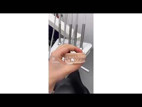 Cas clinique composite injecté – Esthétique
