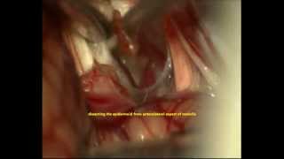 preview picture of video 'TRIGEMINAL NEURALGIA-C-P-ANGLE EPIDERMOID-endoscope- microsurgery-dr suresh dugani/HUBLI/INDIA'