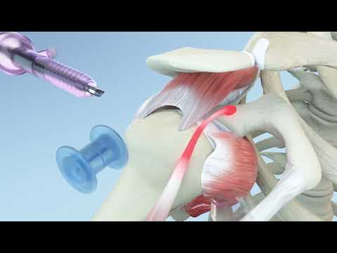 Right Shoulder Rotator Cuff Repair and Biceps Tenodesis Animation