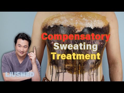 Compensatory Hyperhidrosis Treatment: Non-invasive Thermal Ablation