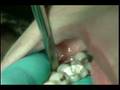 Extraction of tooth #30 with cowhorn and elevator ...