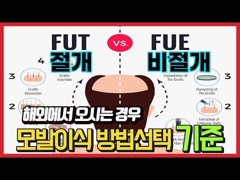 모발이식 미국 일본 해외에서 오시는 경우 ｜ 절개 비절개 모발이식 선택기준