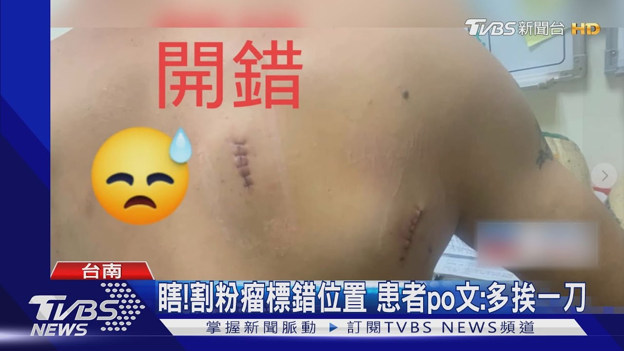 瞎!割粉瘤標錯位置 患者po文:多挨一刀