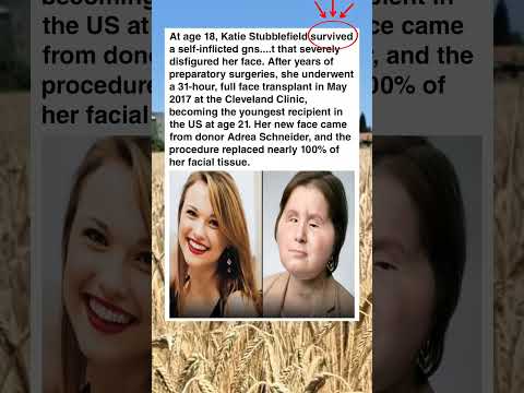 Katie Stubblefield: The Tragic Story of a Face Transplant #shorts #tragicstories #facts