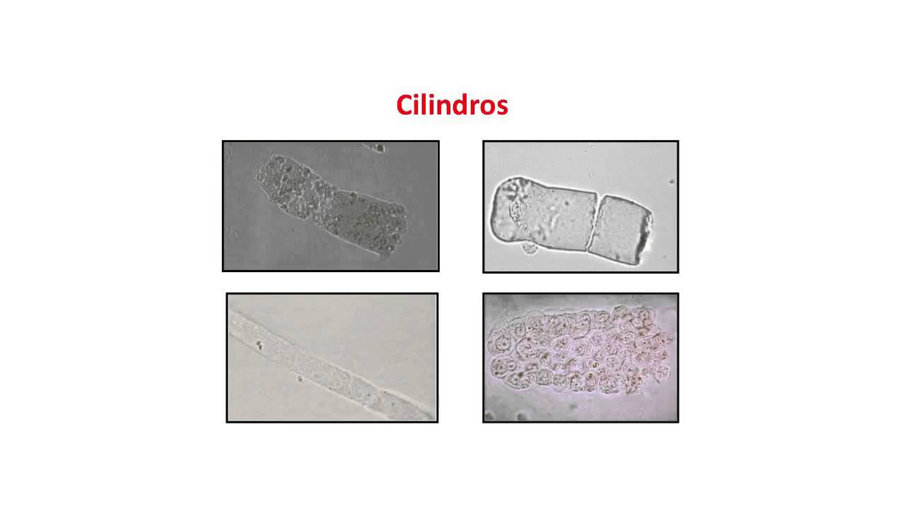 Exame microscópico da urina