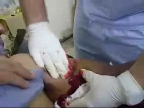 Se é possível aumentar o membro por meio da medicina