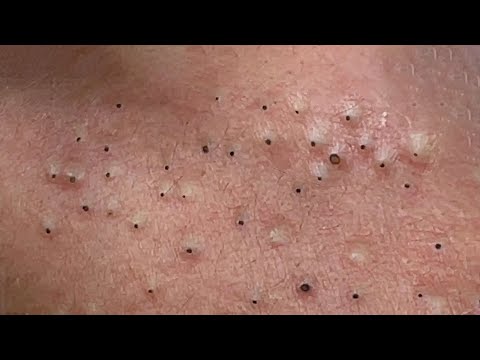 Suri Nguyen Blackhead