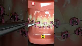 Methods of Ligation Ties #shorts