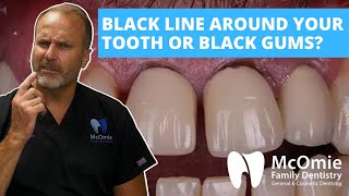 Could a Metal Allergy Be Causing Your Black Gums or Gum Inflammation? Dr. McOmie Explains