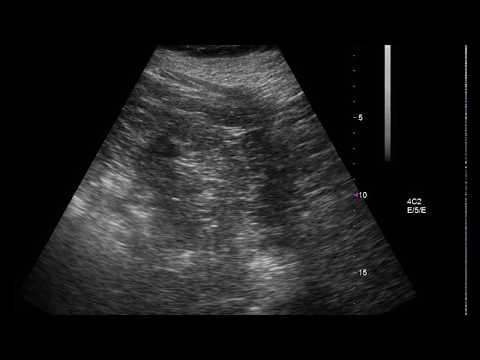 Kutuzov biopsia prostatica Il dolore della prostata dopo una bicicletta