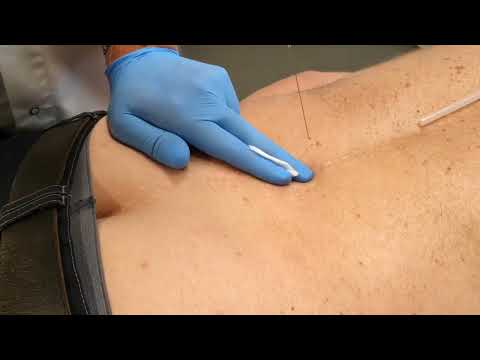 Prolotherapie:  Hoe geneest een letsel na behandeling met Prolotherapie