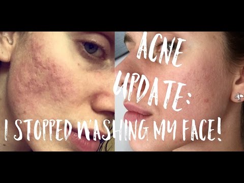 🙊 ACNE UPDATE: I Stopped Washing My Face!!!! | Cassandra Bankson Video
