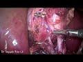 Laparoscopic Cholecystectomy Dangerous Calots Anatomy Dr Tayyab Riaz Ch