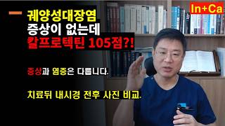 <Entity {'ja': '潰瘍性大腸炎の症状はありませんが、カルプロテクチンは105でした。症状と炎症は異なります。', 'ko': '궤양성대장염 증상이 없는데 칼프로텍틴 105점이었습니다.   증상과 염증은 다릅니다.', 'en': 'I had a calprotectin score of 105 despite having no symptoms of ulcerative colitis. Symptoms and inflammation are different.'}>