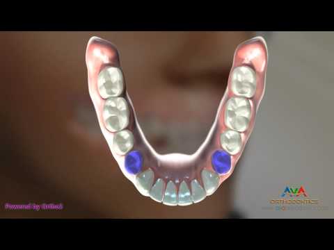 Orthodontic Treatment for Underbite or Crossbite - Removing Lower 1st Premolars