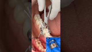 Dental Rubber Dam Isolation  | Complete Step-by-Step Procedure | 3D Dental Animation#DentalRubberDam
