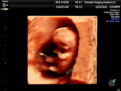 13 week 3D ultrasound